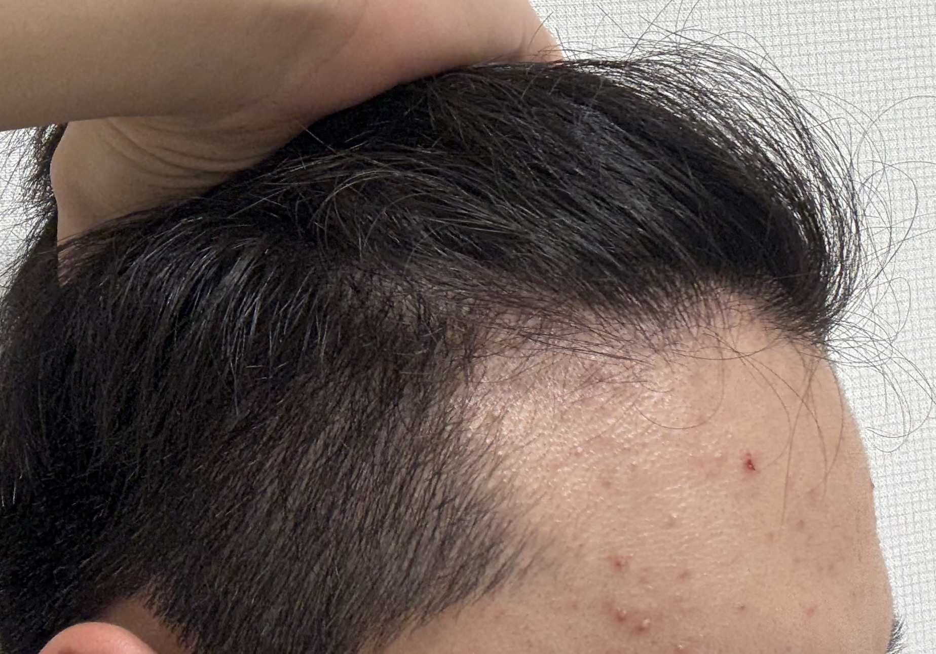 20대 머리 상태/이거 M자 탈모인가요? ㅣ 궁금할 땐, 아하!