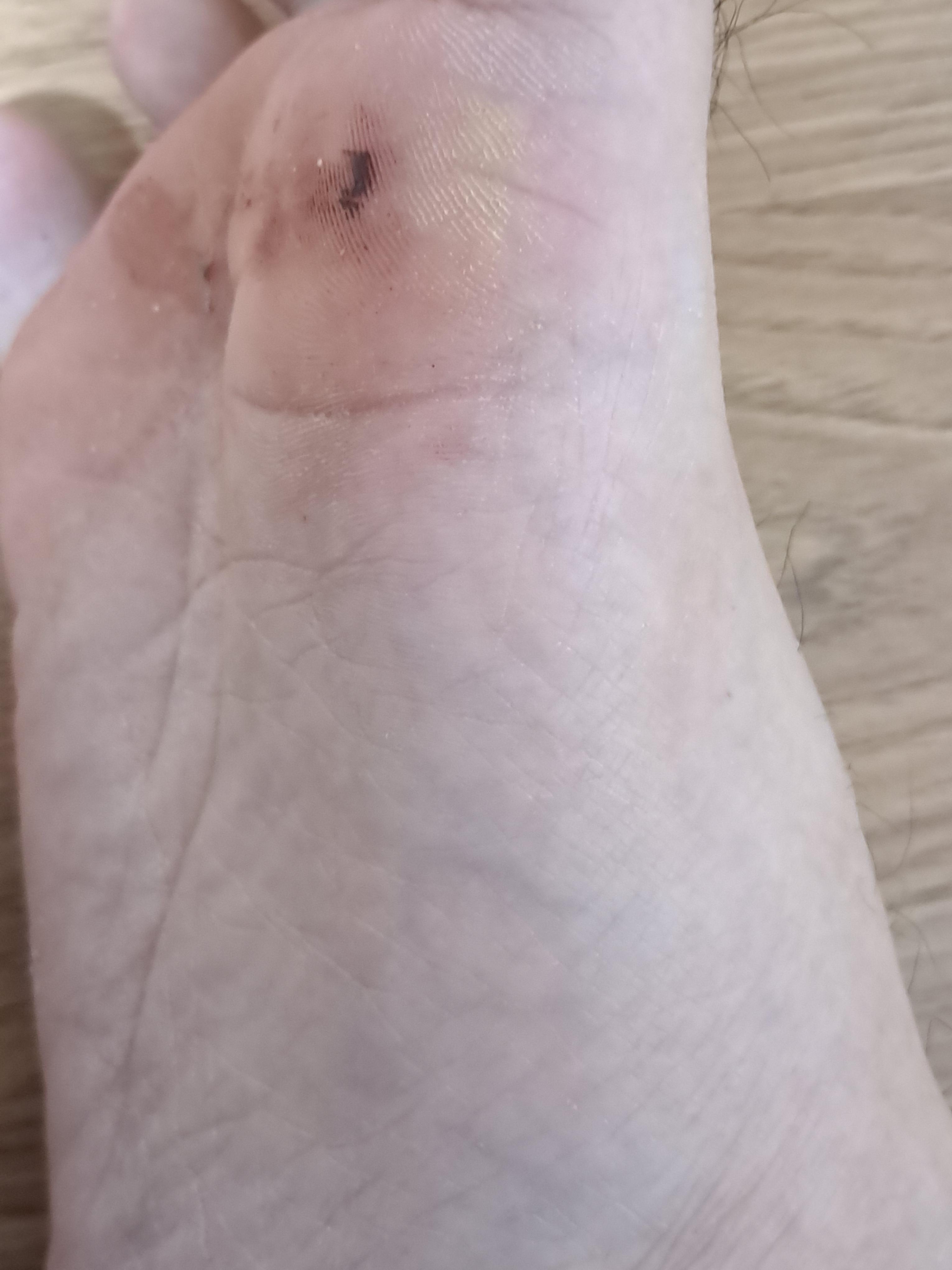 발바닥에 이물질박혀서 이런 상태가 되었네요 ㅣ 궁금할 땐, 아하!