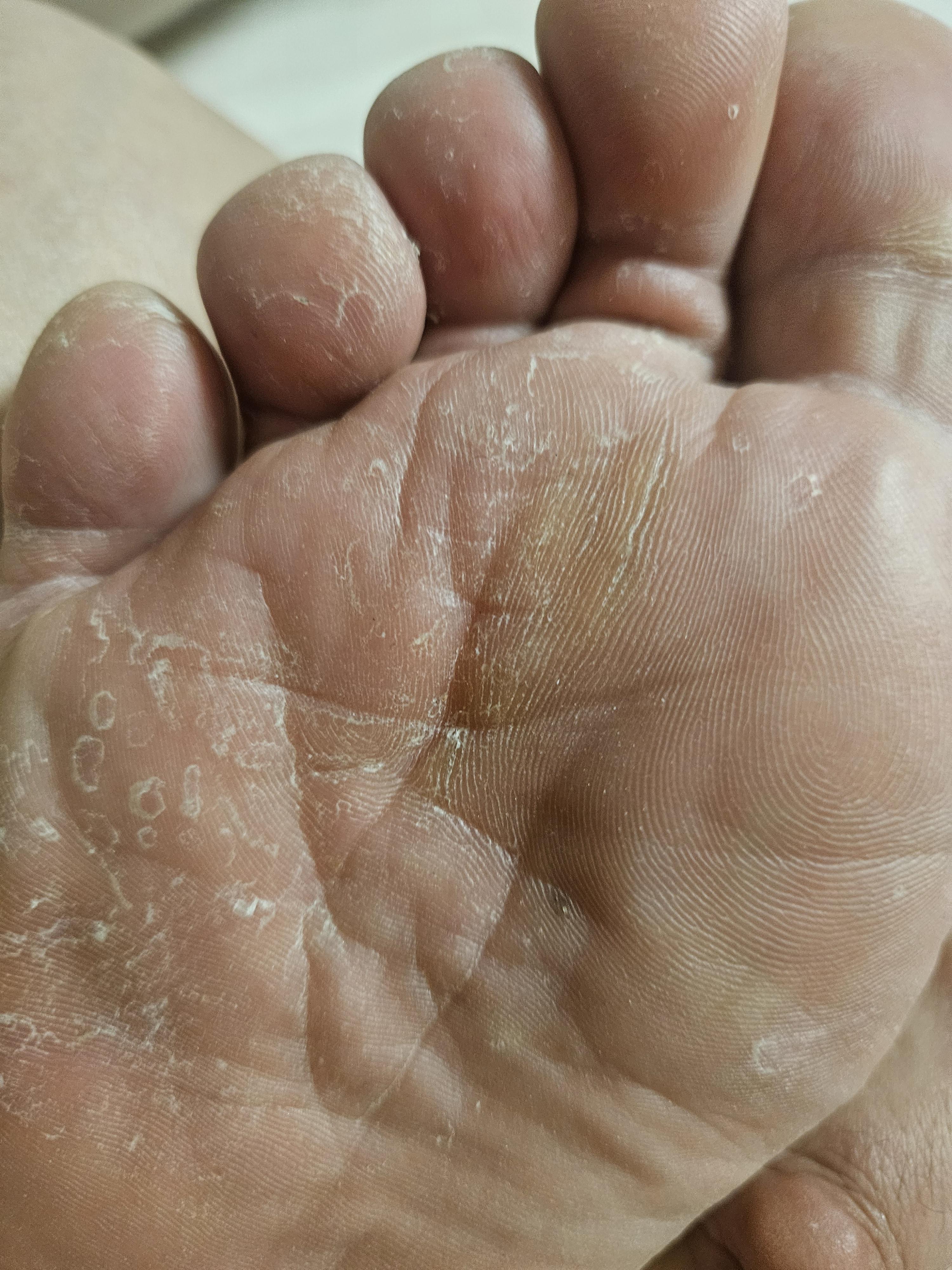 무좀 약 추천 해주세요. (아래 사진 참고) ㅣ 궁금할 땐, 아하!