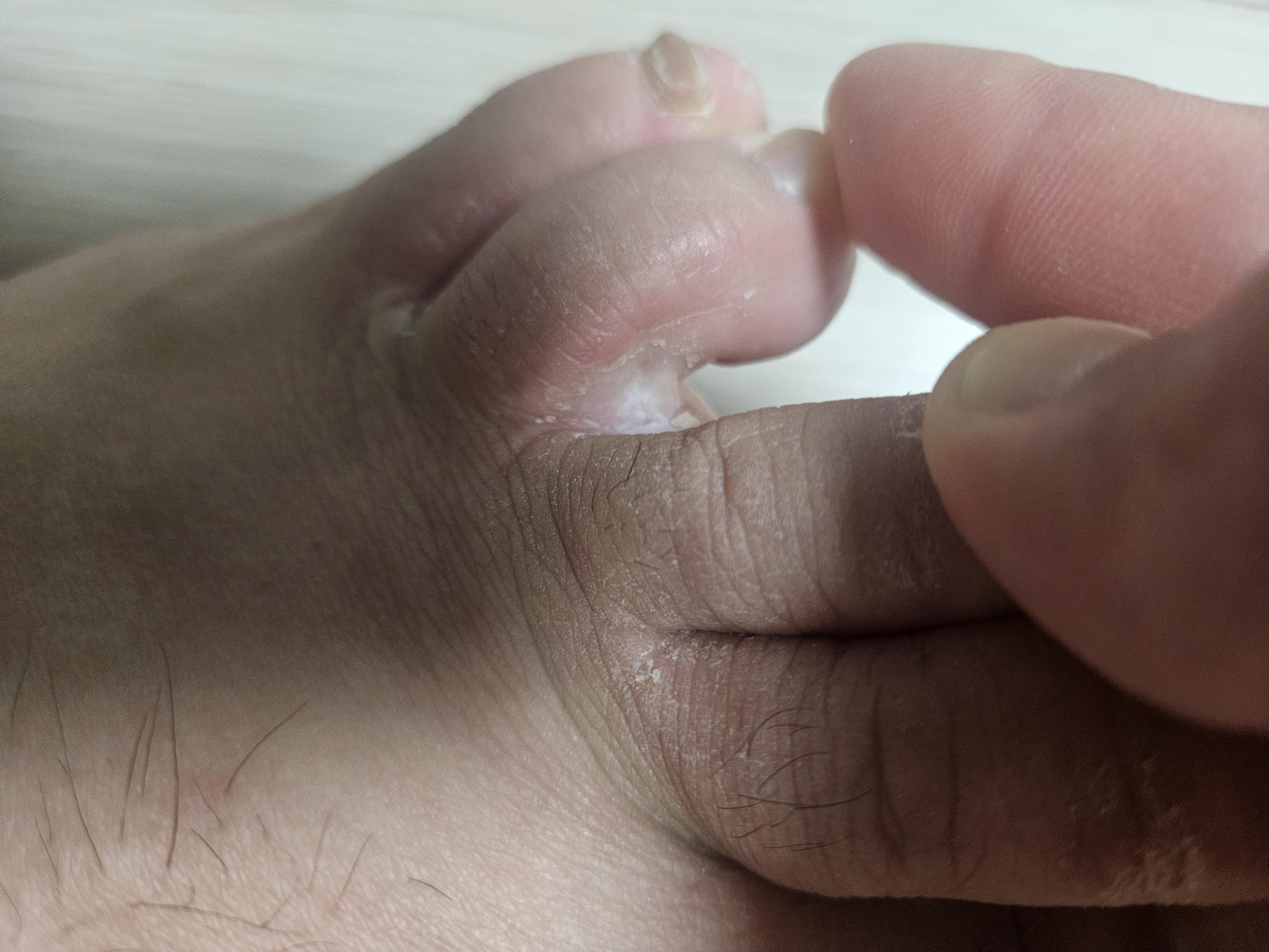 무좀 약 추천 해주세요. (아래 사진 참고) ㅣ 궁금할 땐, 아하!