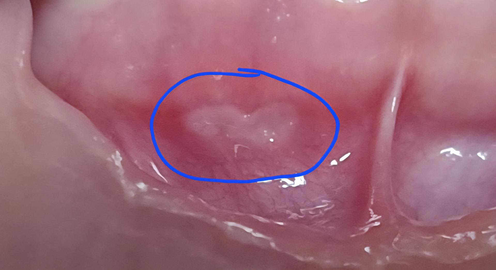임산부 구내염에 페리톡겔 발라도 될까요? ㅣ 궁금할 땐, 아하!