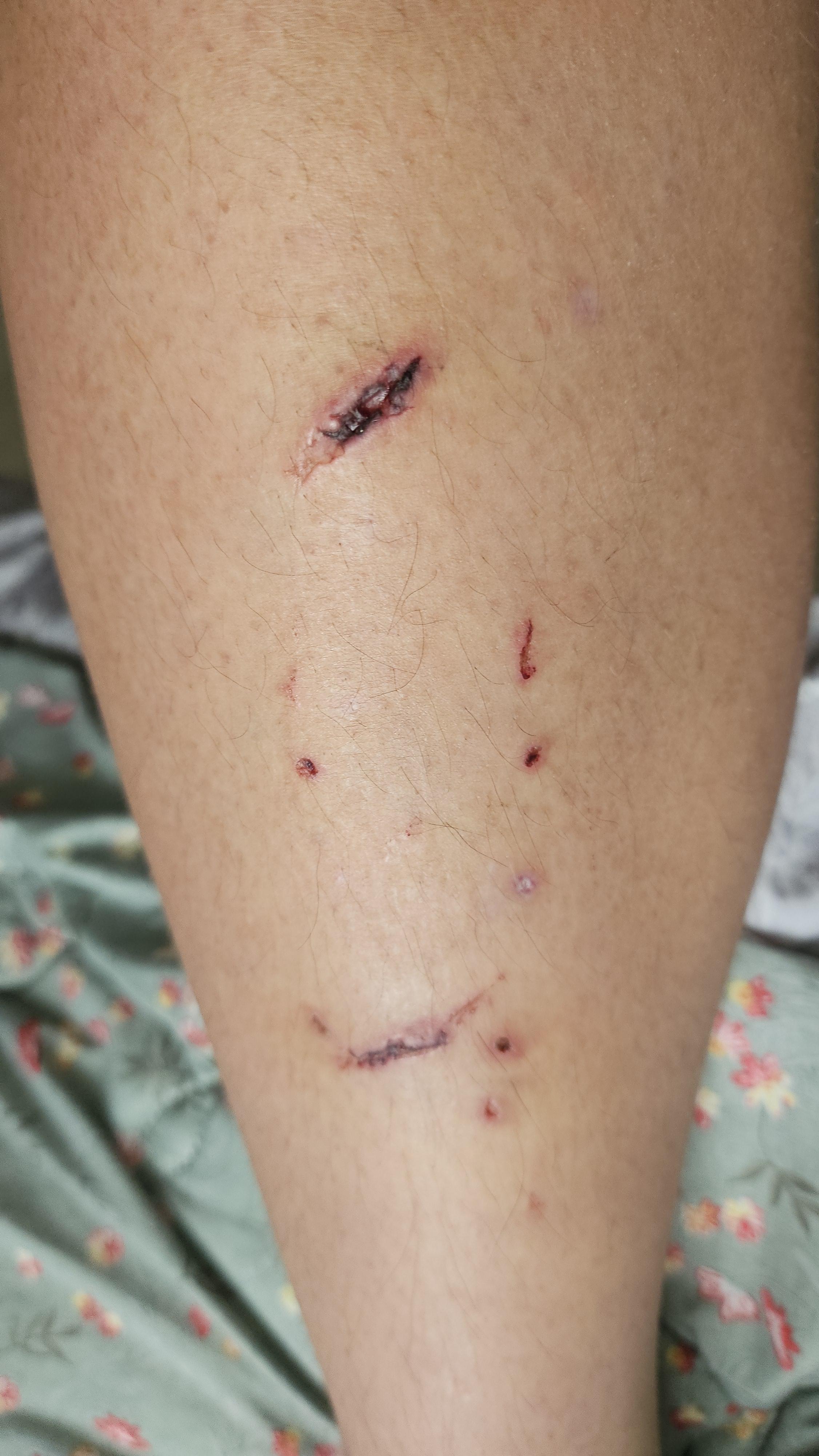 살이 패였는상처가 점점 검게 변하고있는데 괜찮은건가요 ㅣ 궁금할 땐, 아하!