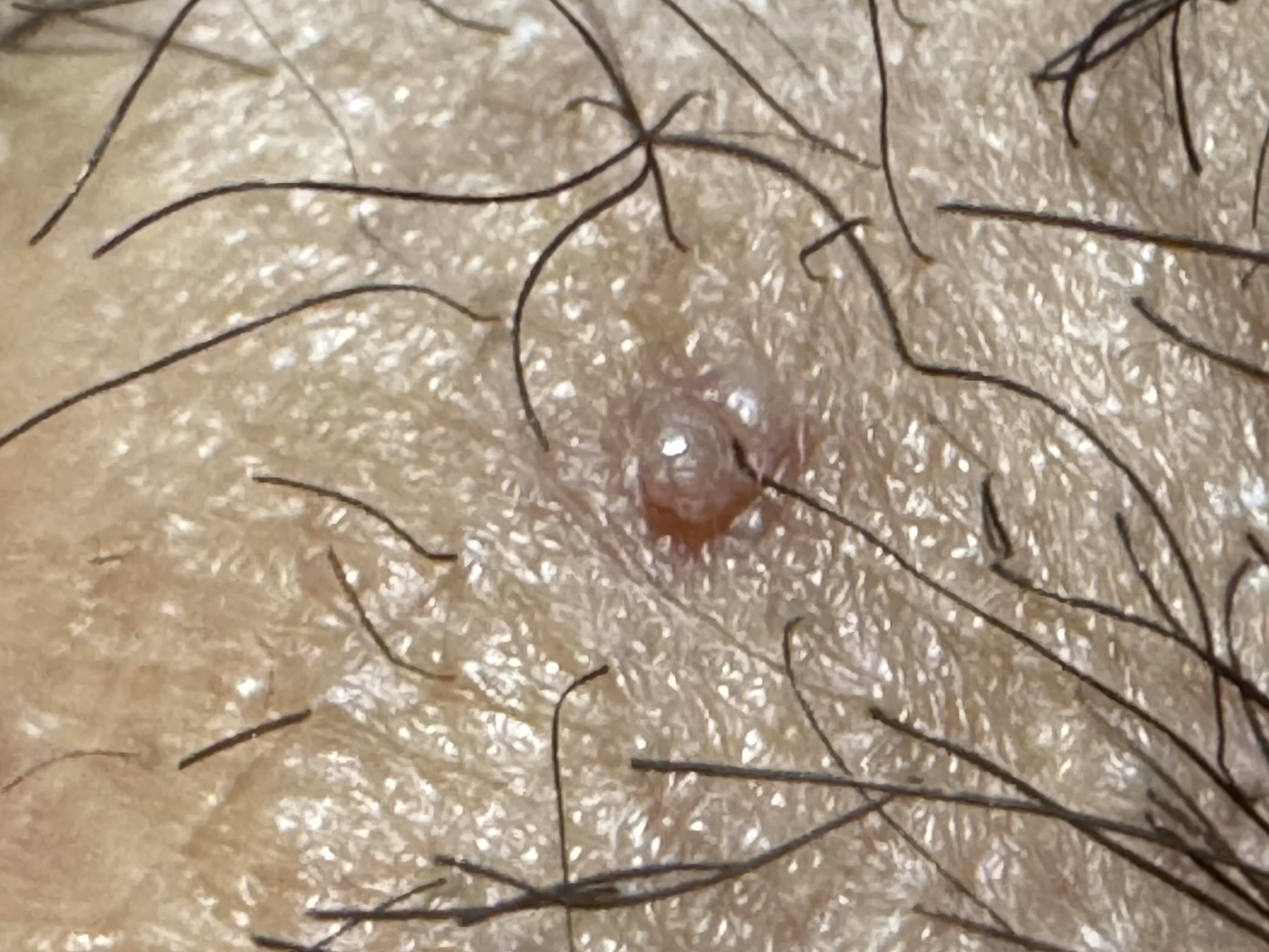 성기 사마귀? 쥐젖? 뭔지 알고싶습니다 ㅣ 궁금할 땐, 아하!