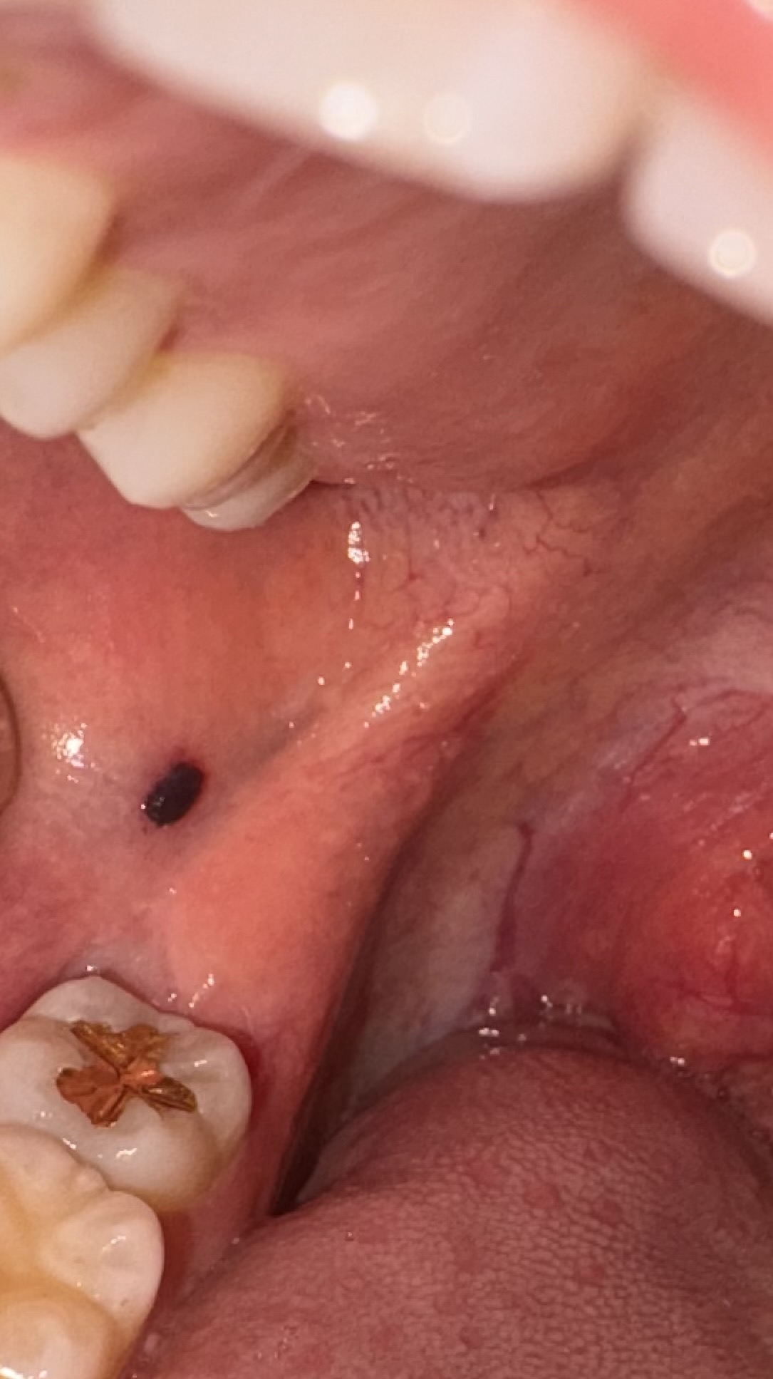 입안에 피멍울 같은 게 생겼는데 놔둬야 하나요?? ㅣ 궁금할 땐, 아하!