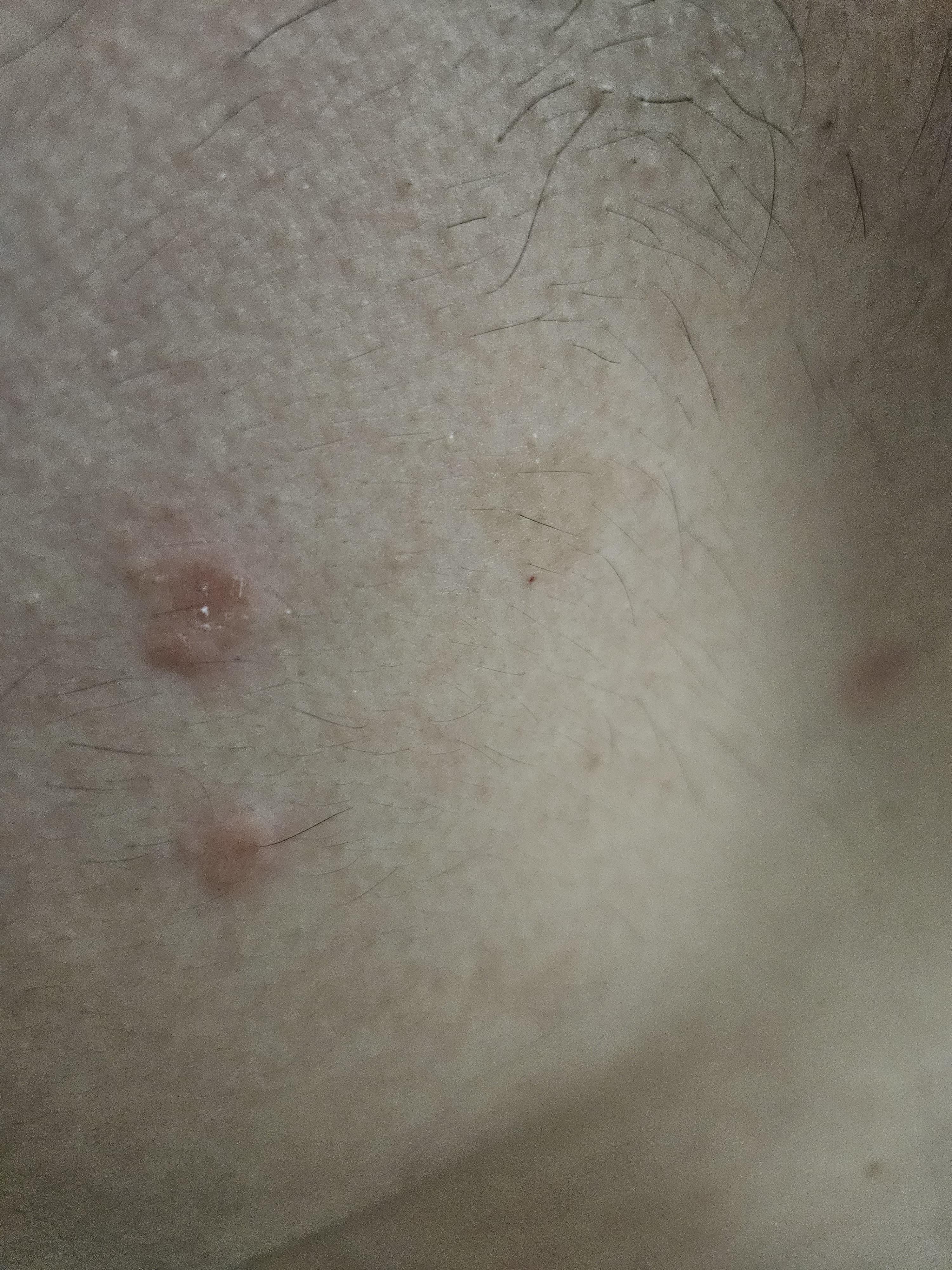 몸에 붉은 반점이 많이 생겼는데 이게 무엇일까요? ㅣ 궁금할 땐, 아하!