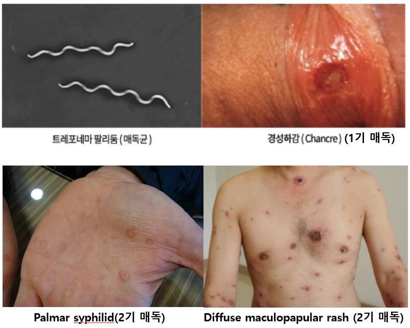 매독.PNG 이미지