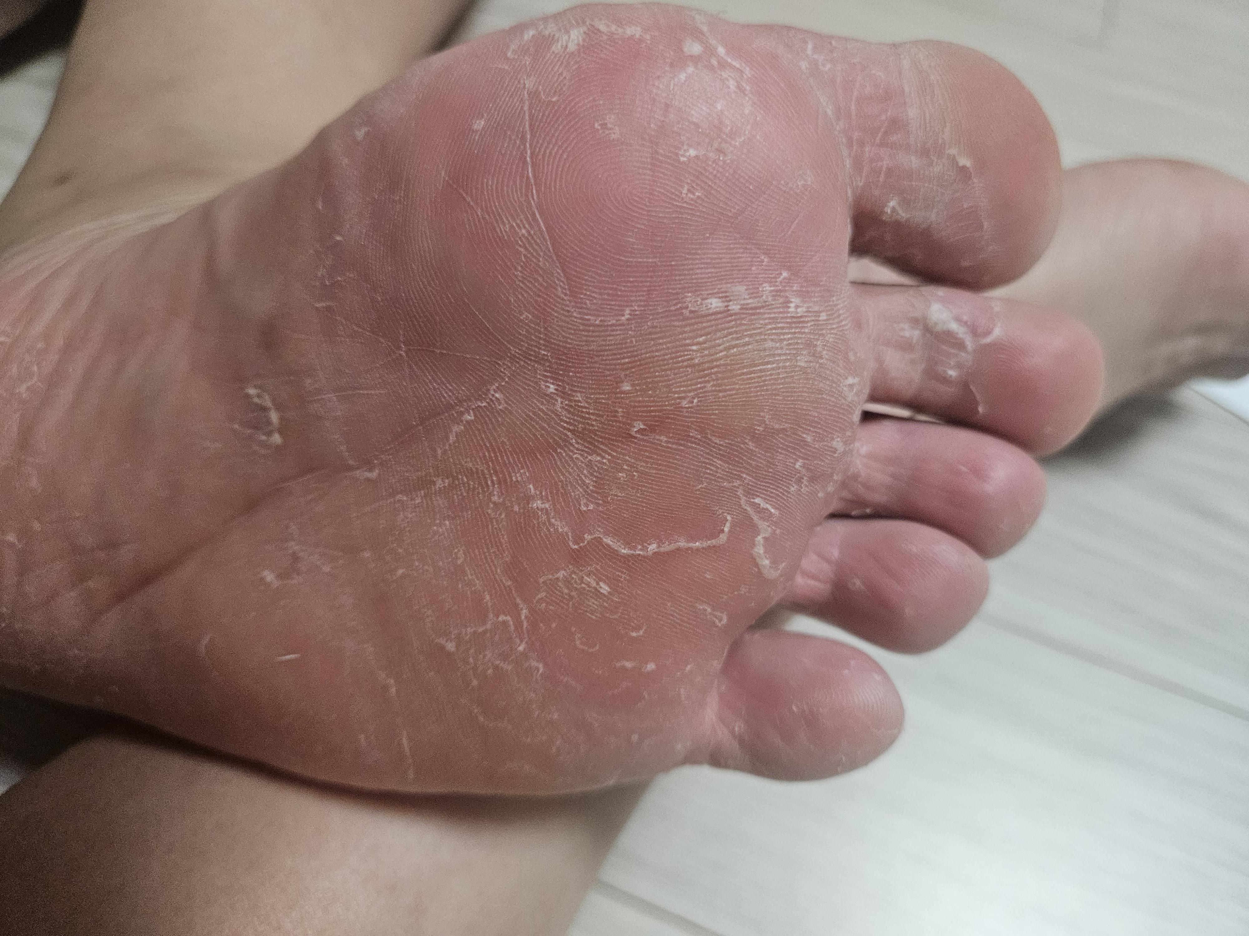 무좀 약 추천 해주세요. (아래 사진 참고) ㅣ 궁금할 땐, 아하!