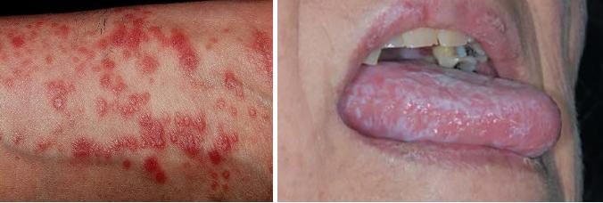 편평태선.PNG 이미지