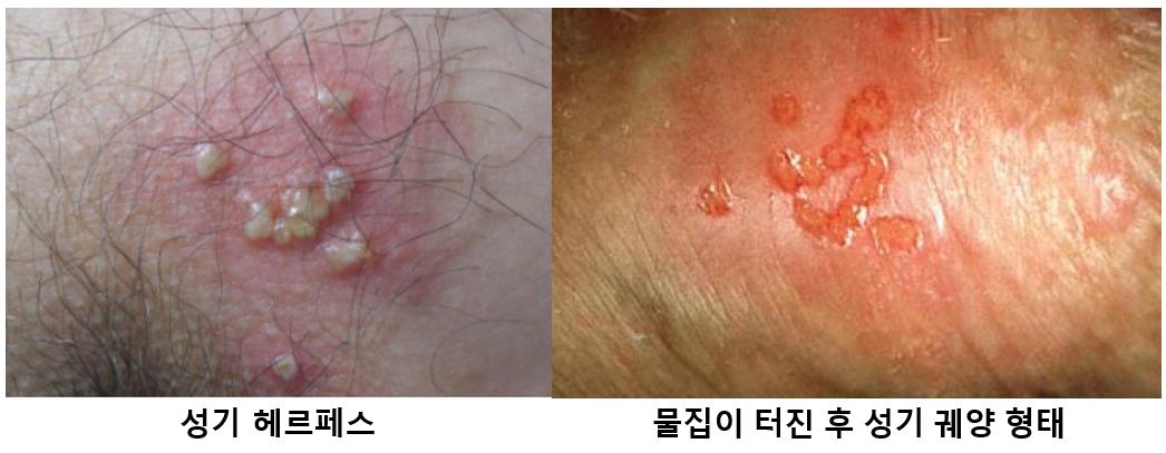 헤르페스.PNG 이미지