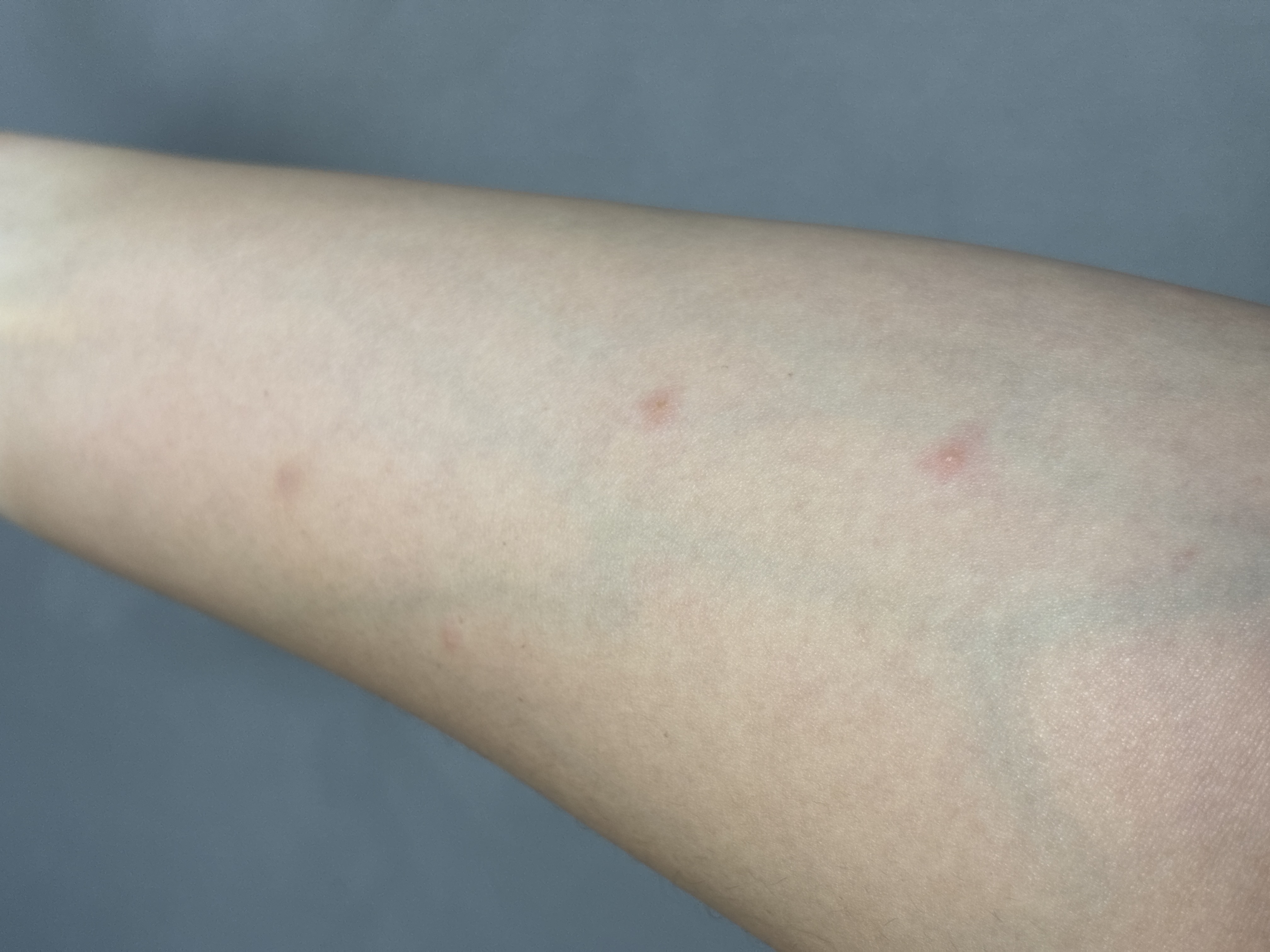 한쪽 팔에만 두드러기?같은게 났어요 ㅣ 궁금할 땐, 아하!