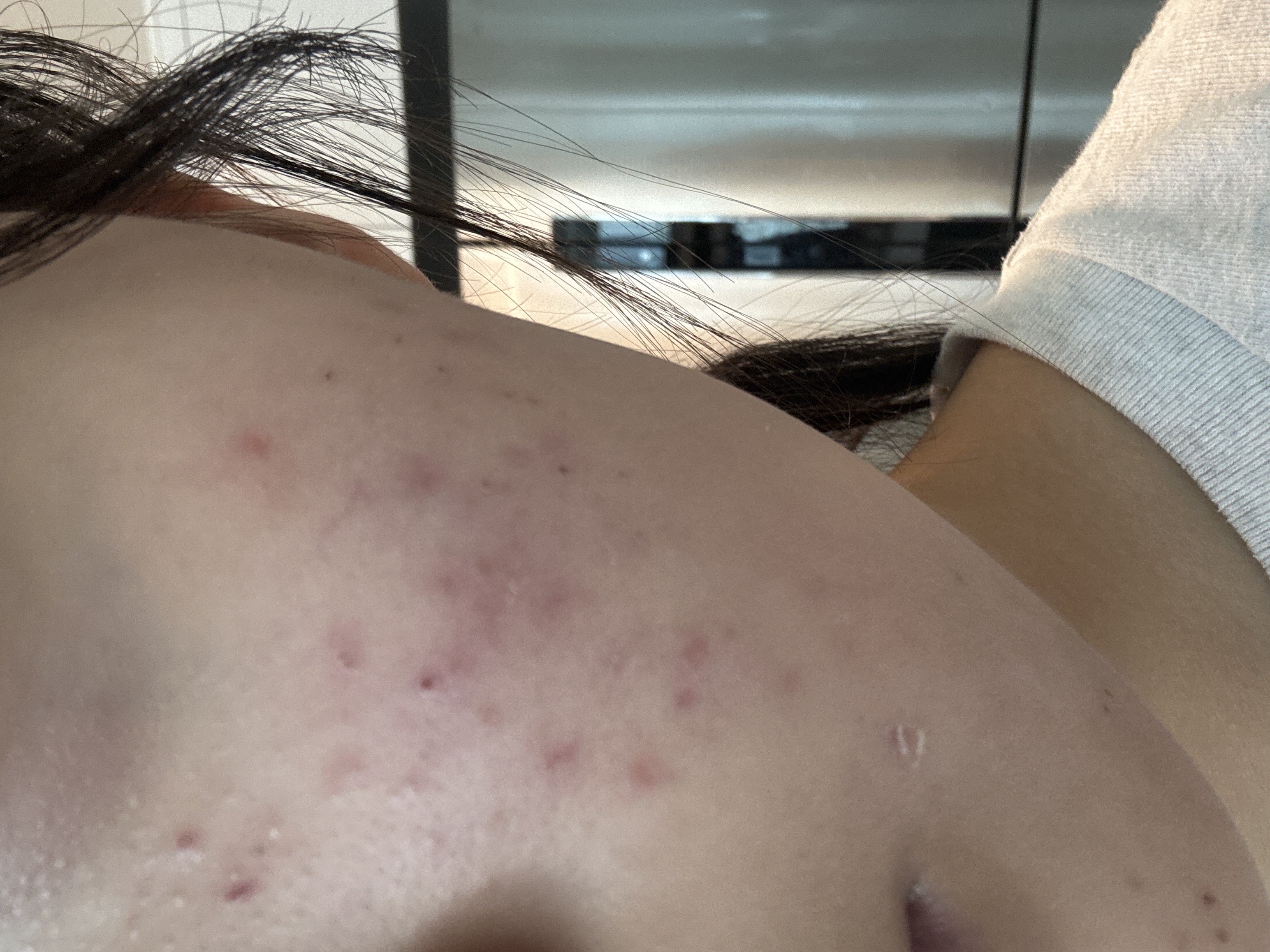 압출하고 딱지가 떨어졌는데 거기에 볼록하게 튀어나왔는데 다시 생긴걸까요? ㅣ 궁금할 땐, 아하!