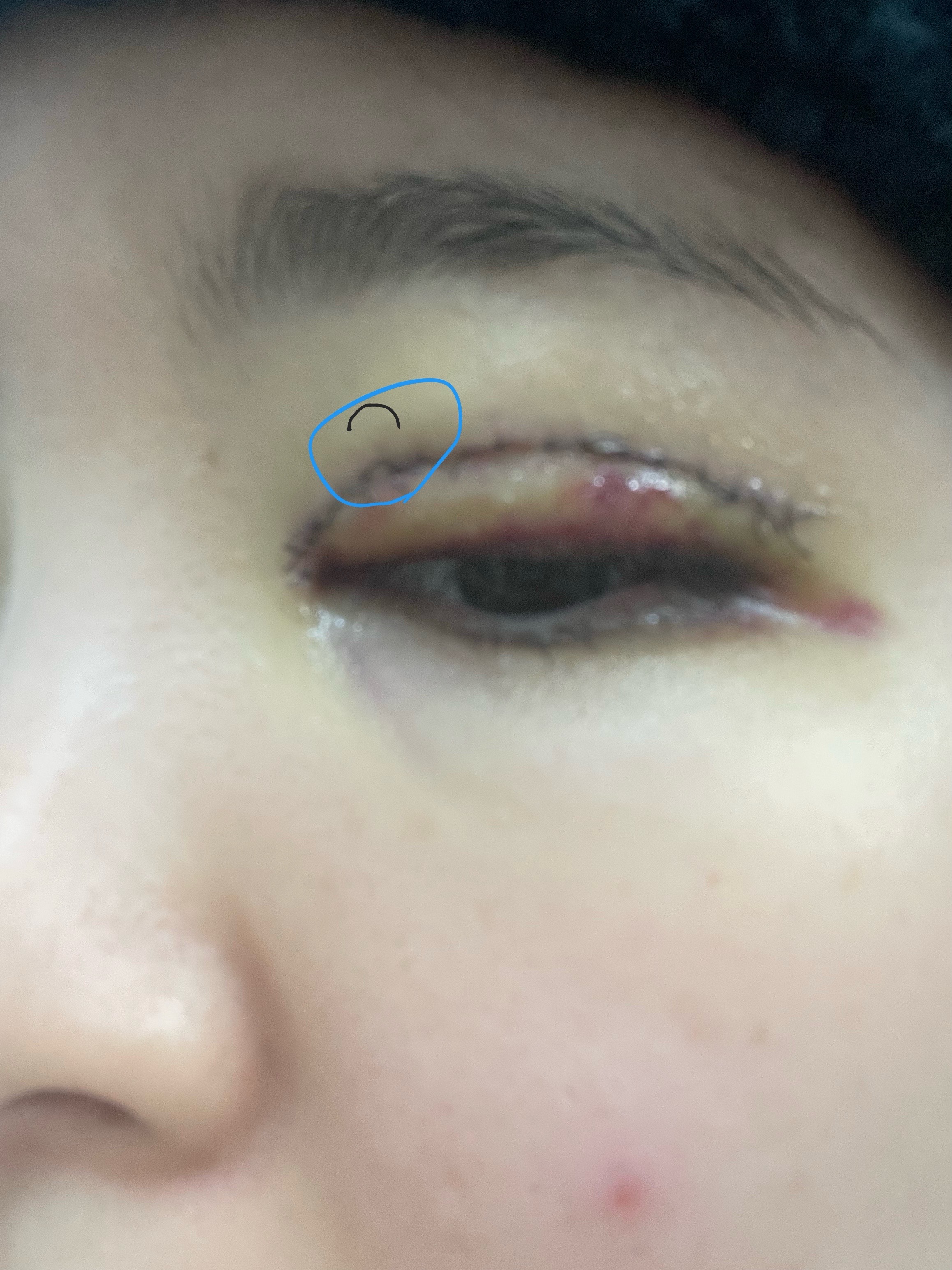 절개 쌍수 실밥 헐거워졌는데 괜찮나요 ㅣ 궁금할 땐, 아하!