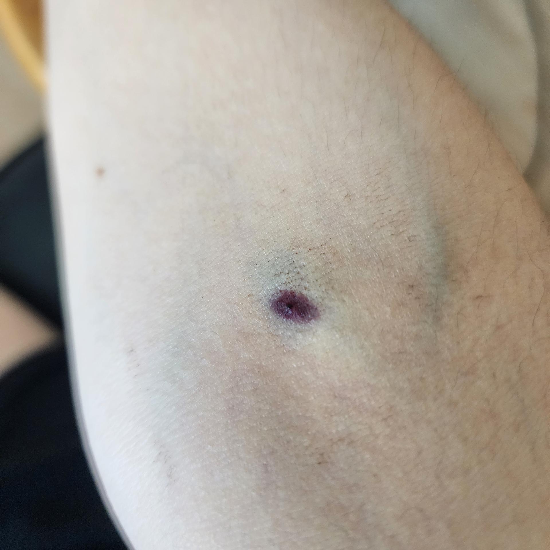 링거 뺀 자리 상처가 보라색으로 너무 이상해요 ㅣ 궁금할 땐, 아하!