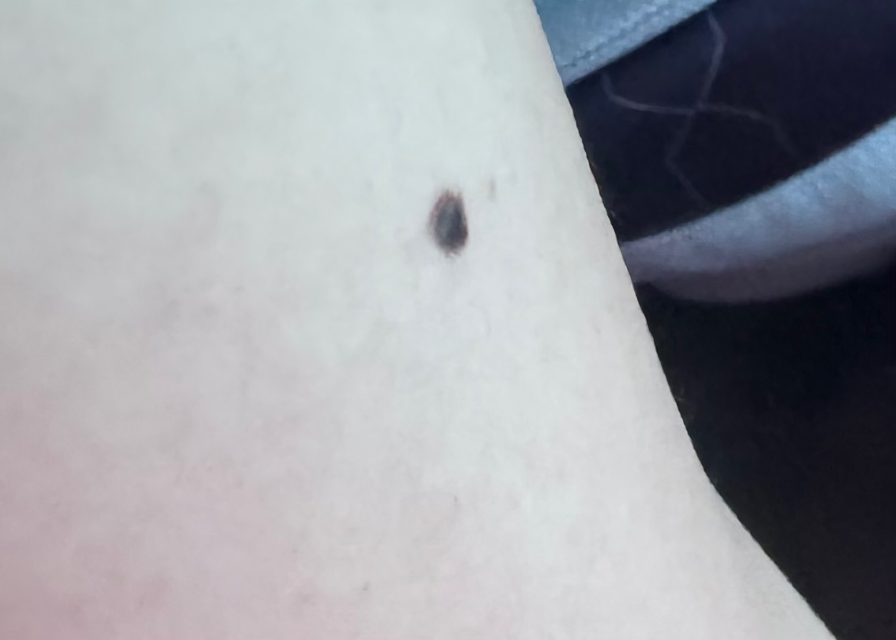 검은색 점이 생겼는데 흑색종일까요? ㅣ 궁금할 땐, 아하!