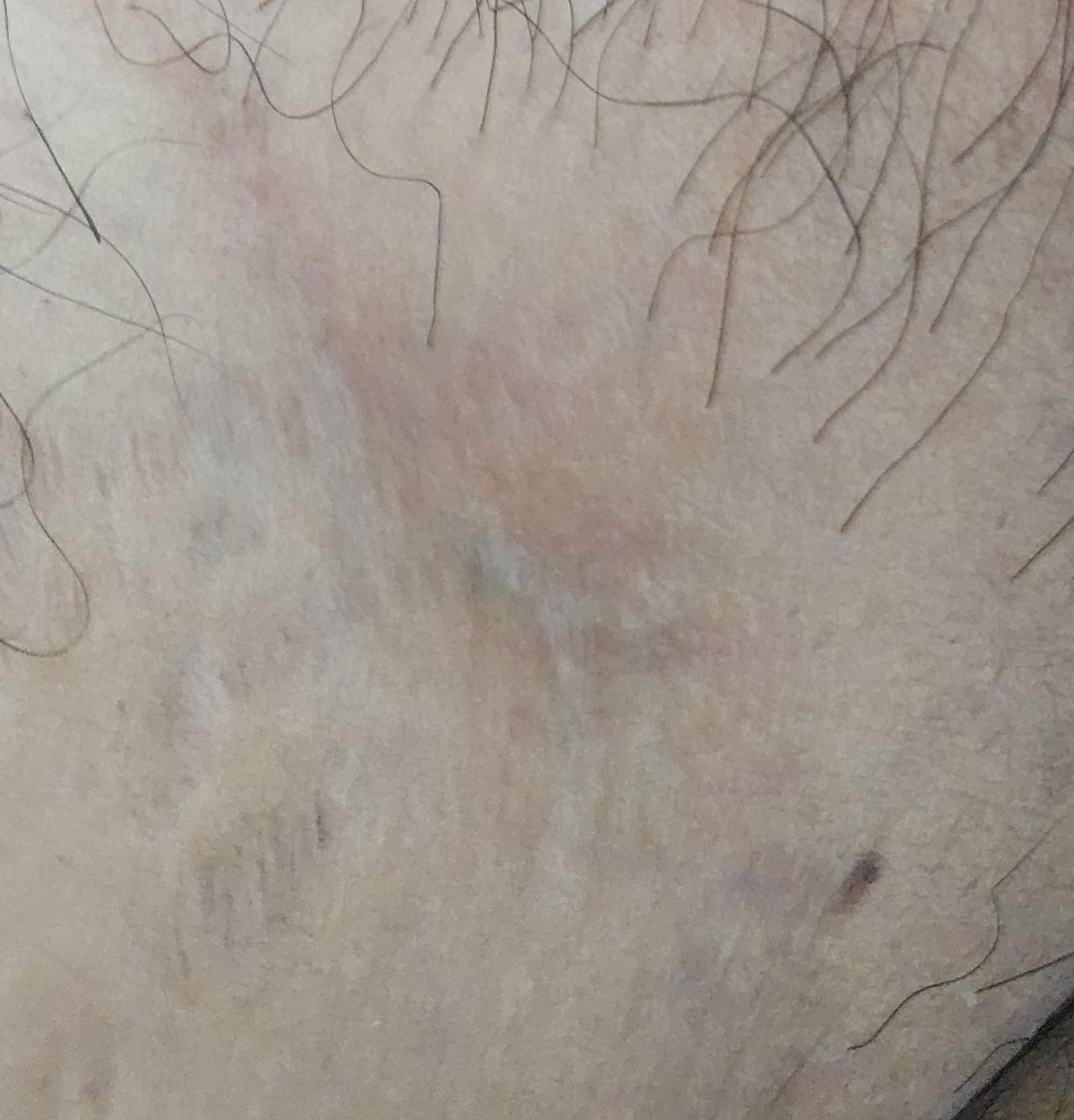 사타구니쪽에 이거 혹시 사타구니 백선 증상일까요? ㅣ 궁금할 땐, 아하!