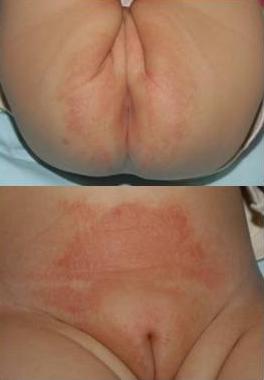 접촉피부.PNG 이미지