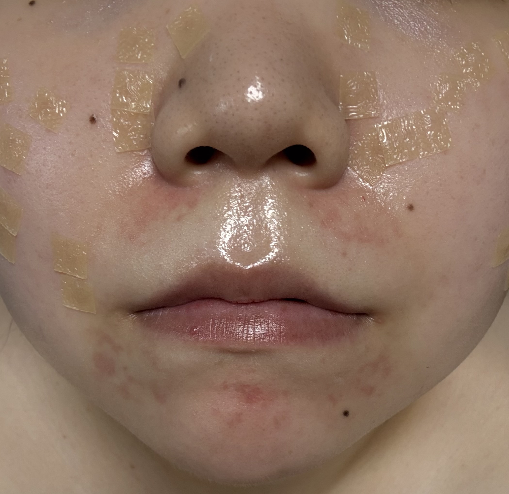 피부과 마취크림 부작용으로 하티손 1% 로션 사용 가능 유무 ㅣ 궁금할 땐, 아하!