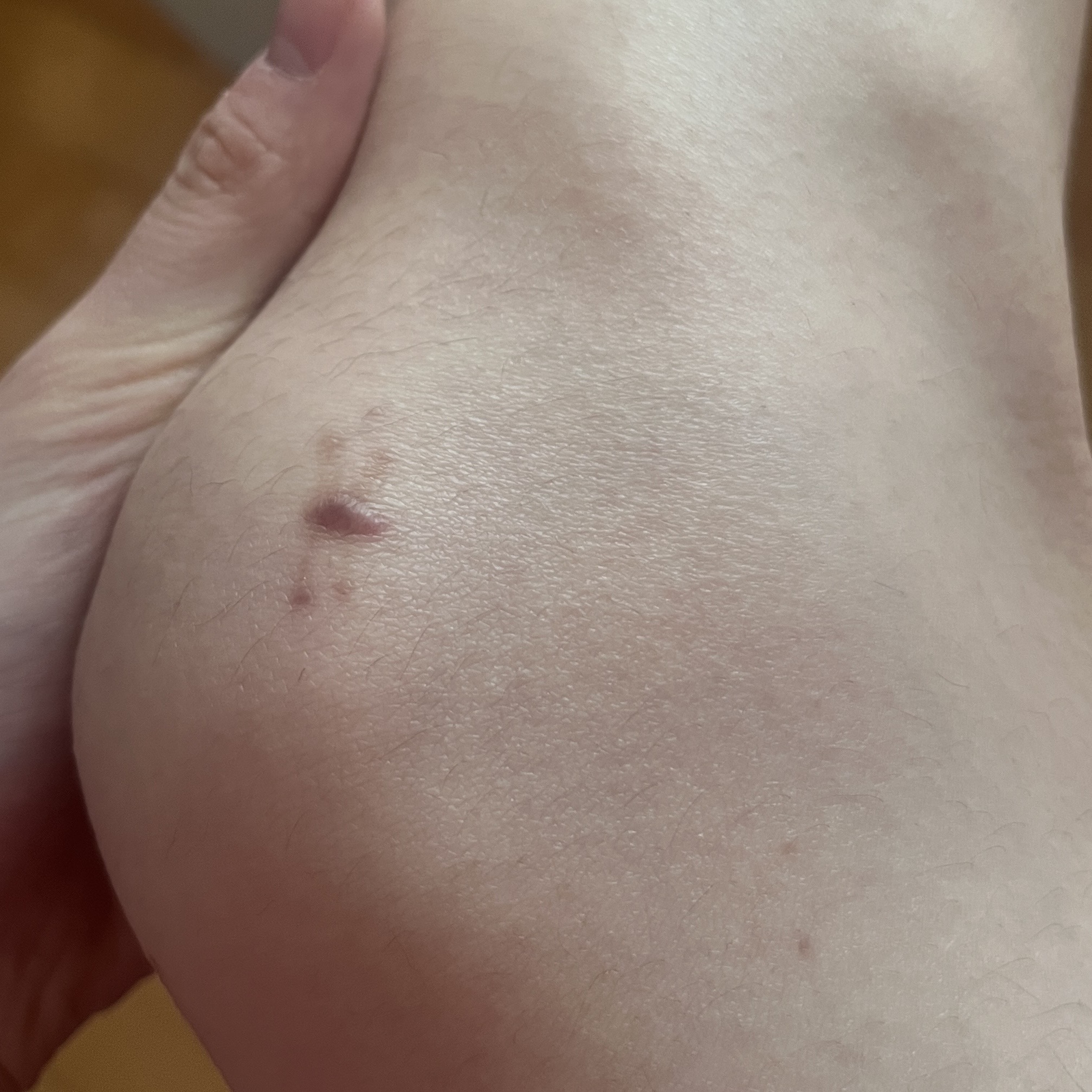 무릎 관절경 수술 후 흉터? 치료 필요할까요 ㅣ 궁금할 땐, 아하!