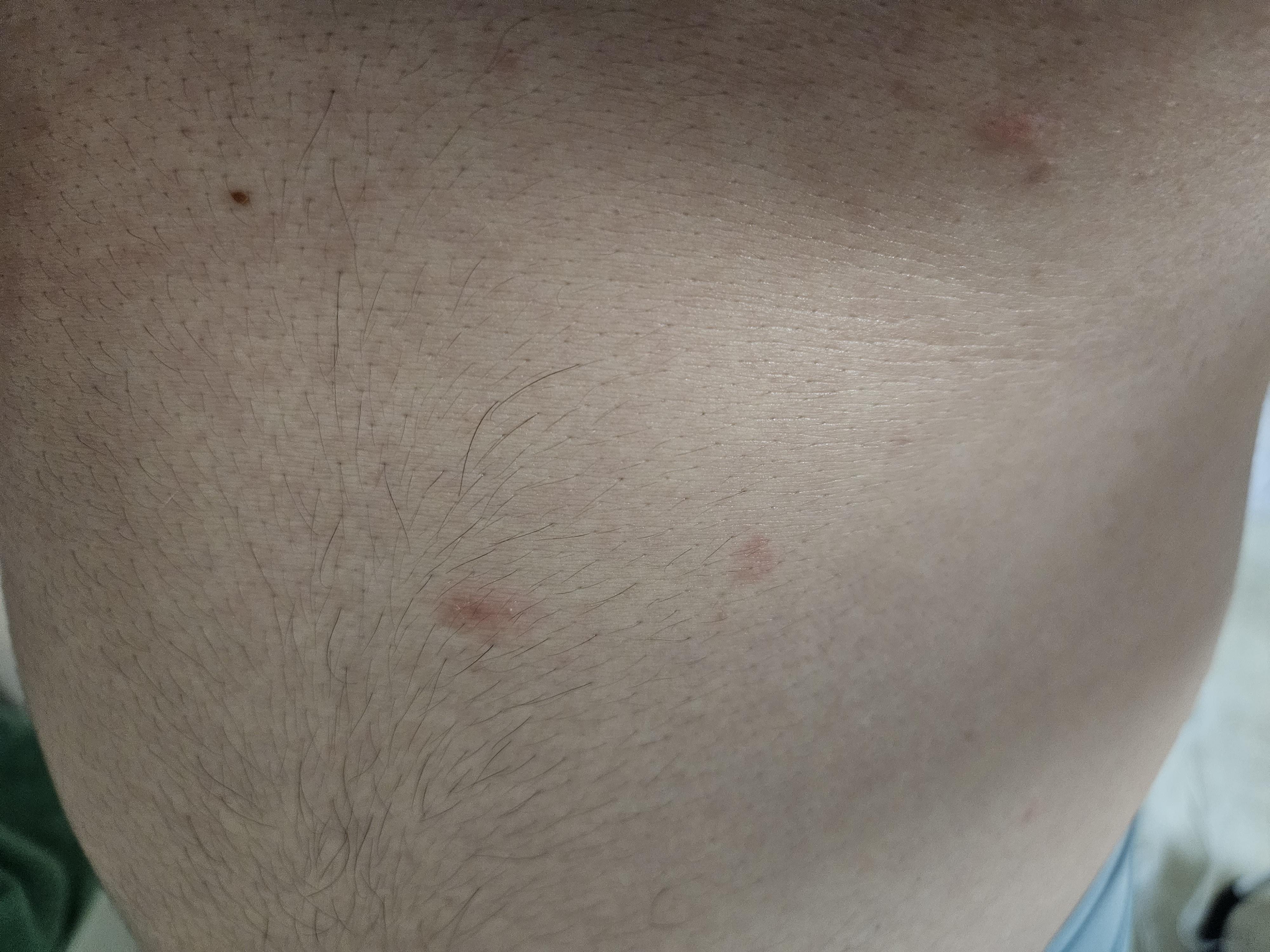 몸에 붉은 반점이 많이 생겼는데 이게 무엇일까요? ㅣ 궁금할 땐, 아하!