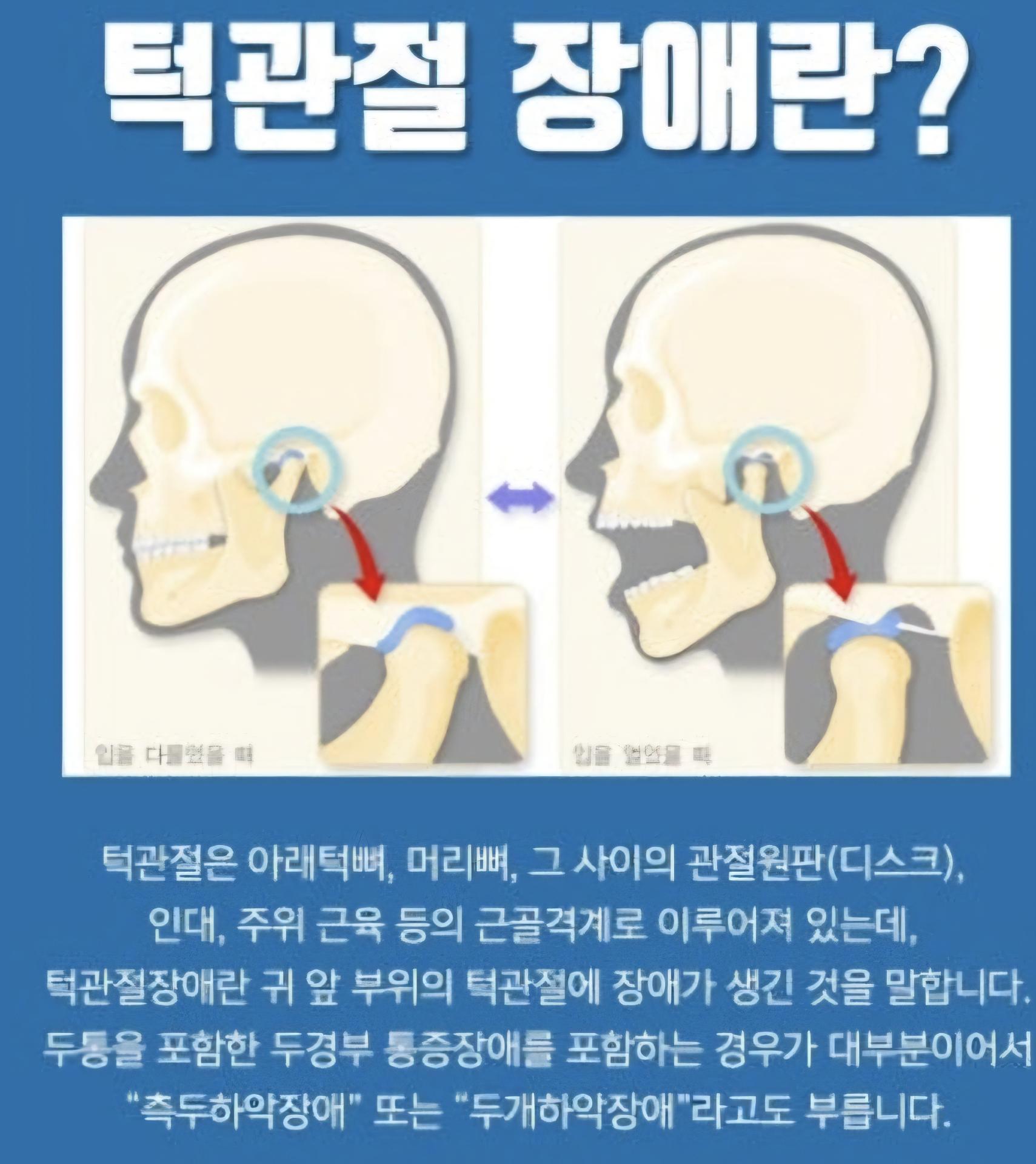 턱관절이상이생긴거같아요 답변꼭좀 부탁드립니다ㅠ ㅣ 궁금할 땐, 아하!