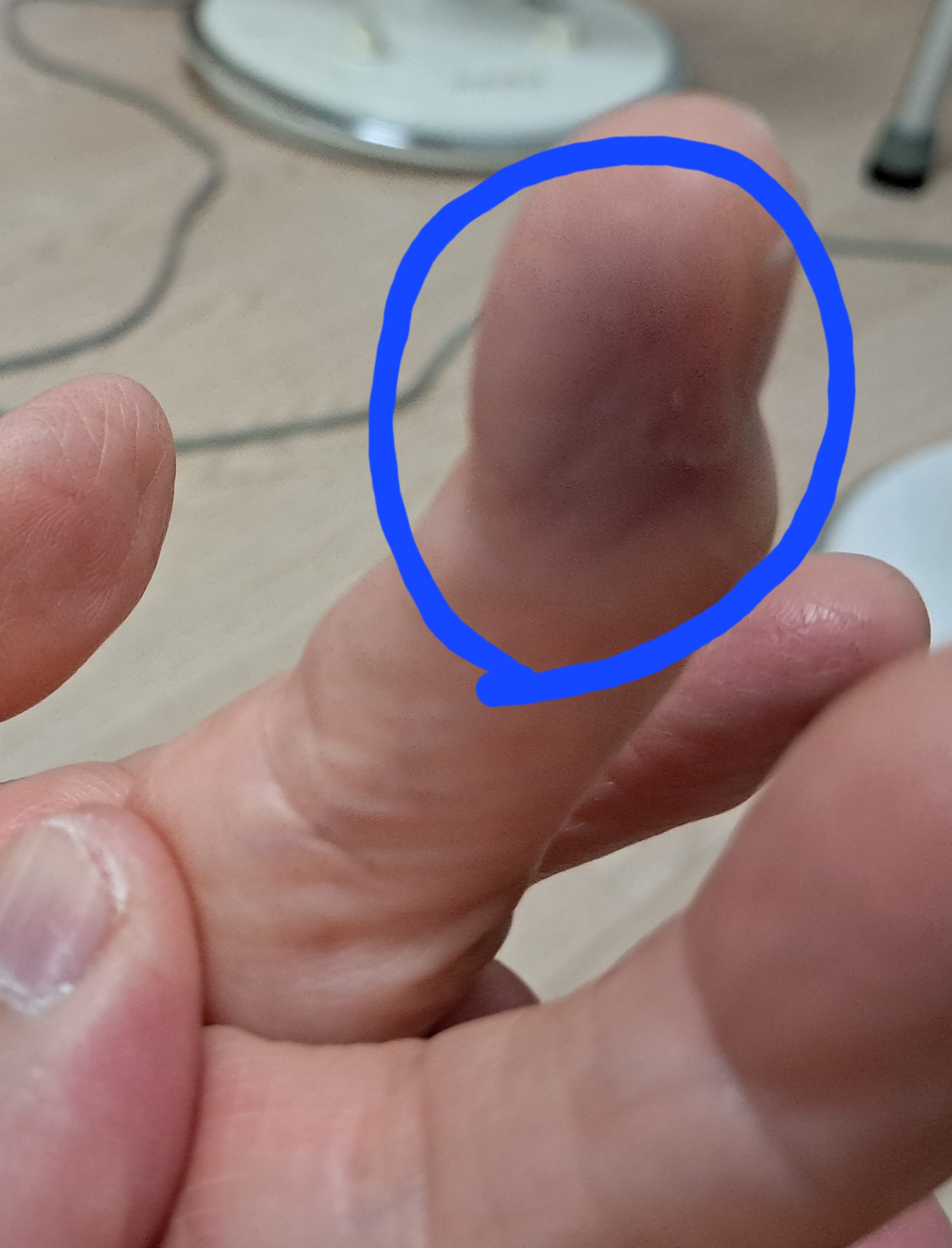 바늘로 찌른 자리에 멍이 들수도 있나요? ㅣ 궁금할 땐, 아하!