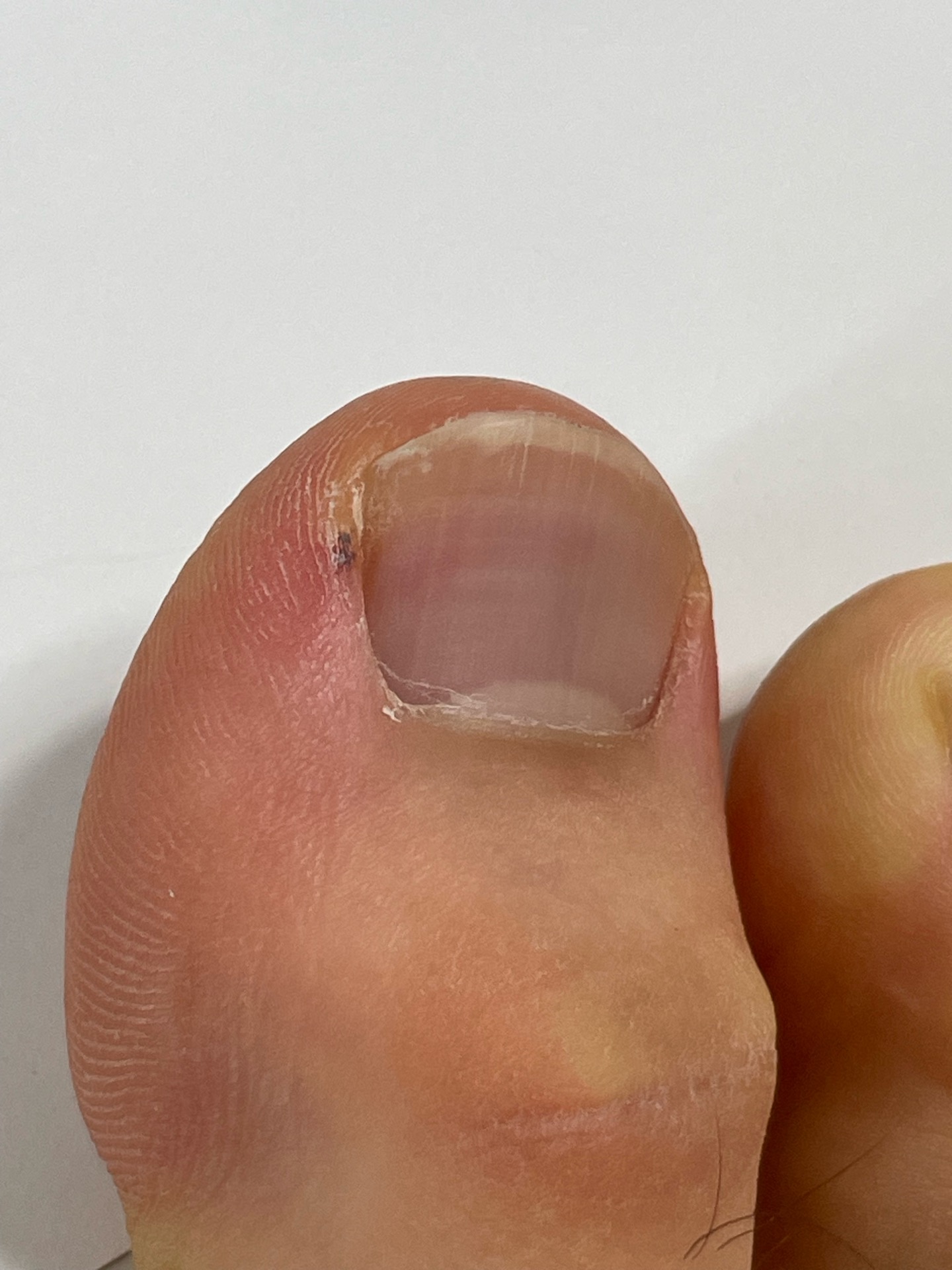 엄지발가락에 검은색 점이 생겼어요. ㅣ 궁금할 땐, 아하!