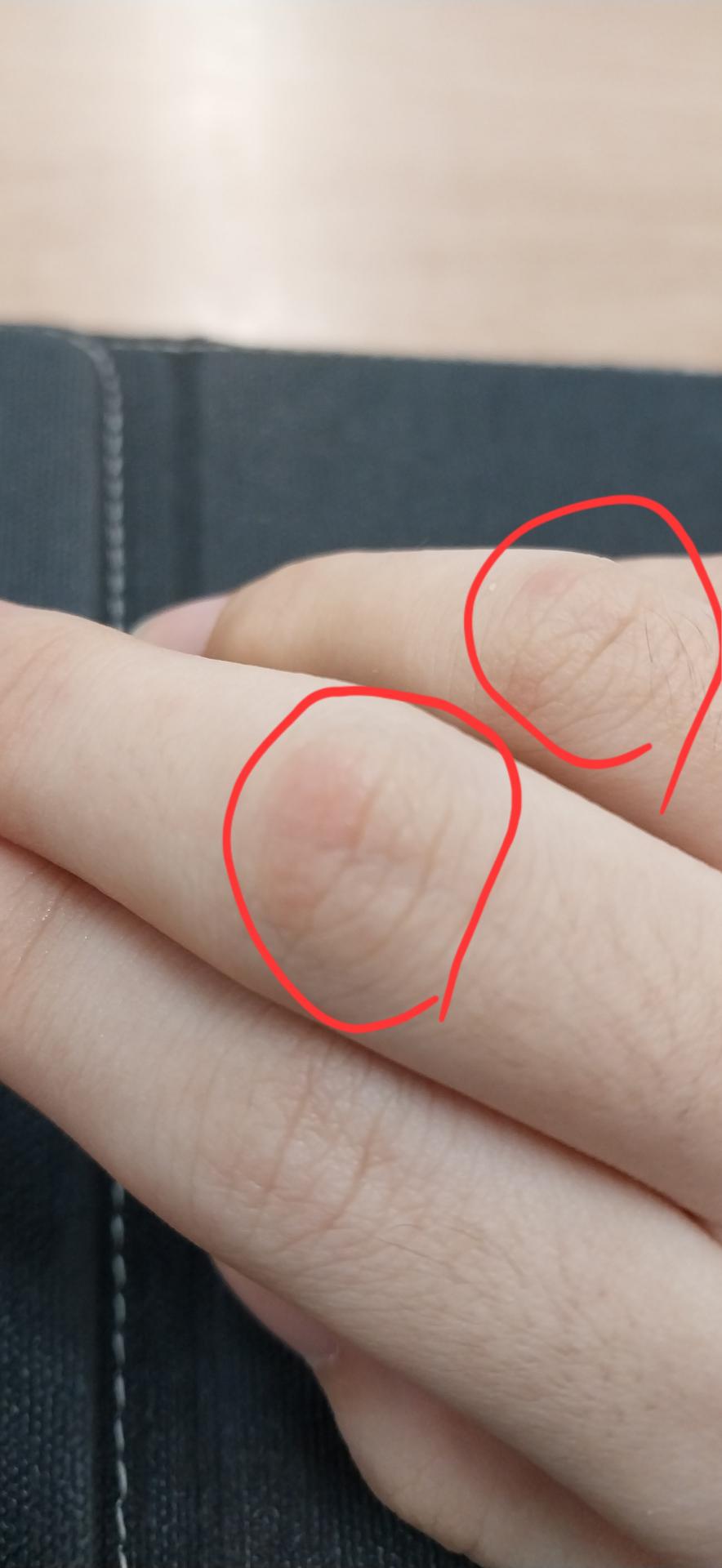 손가락 마디 뻐근함과 멍이 자꾸 생겨요 ㅣ 궁금할 땐, 아하!