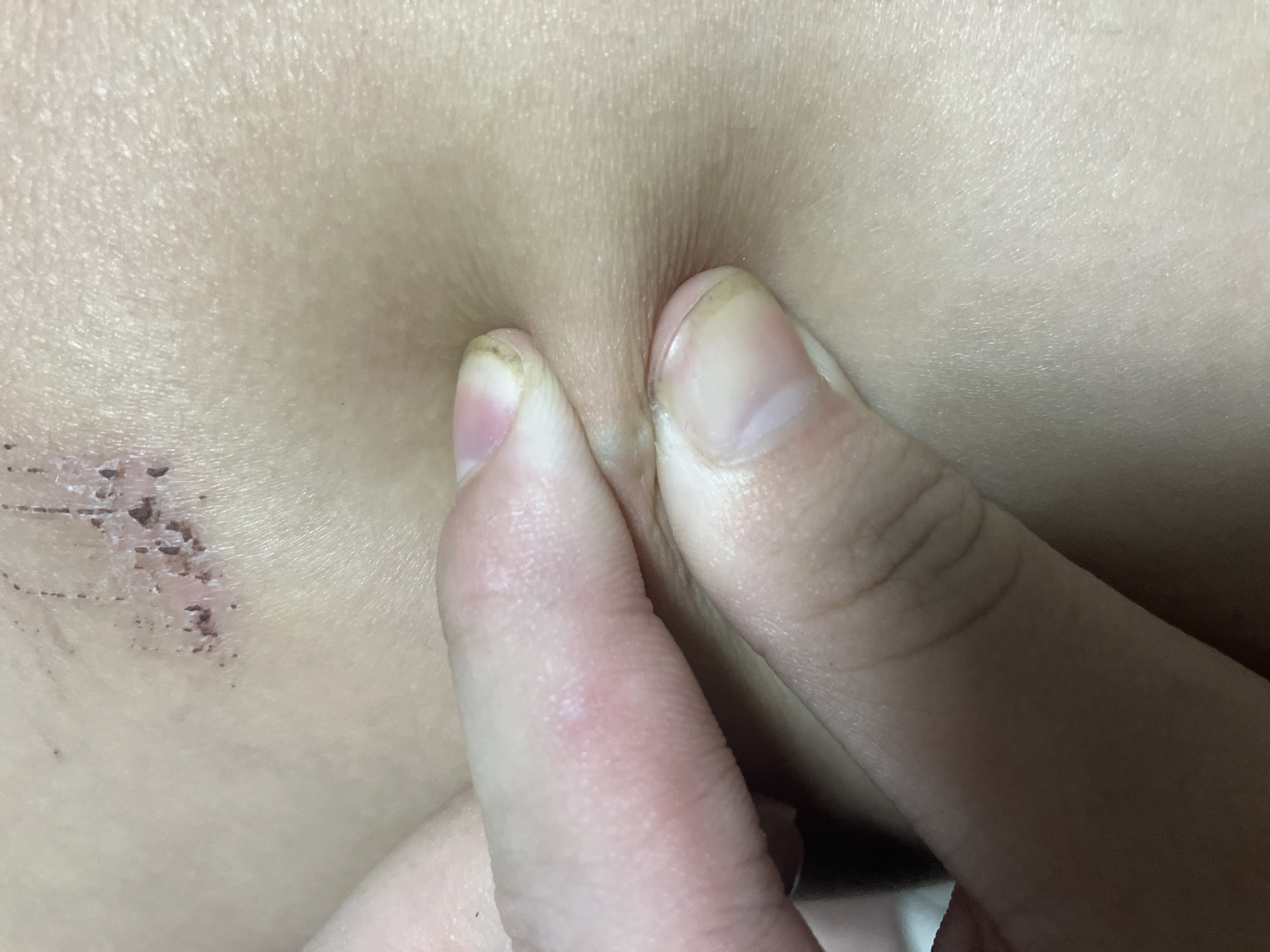 무릎위쪽 살안에 검은색 딱딱한게 있는데 뭔가요?? ㅣ 궁금할 땐, 아하!