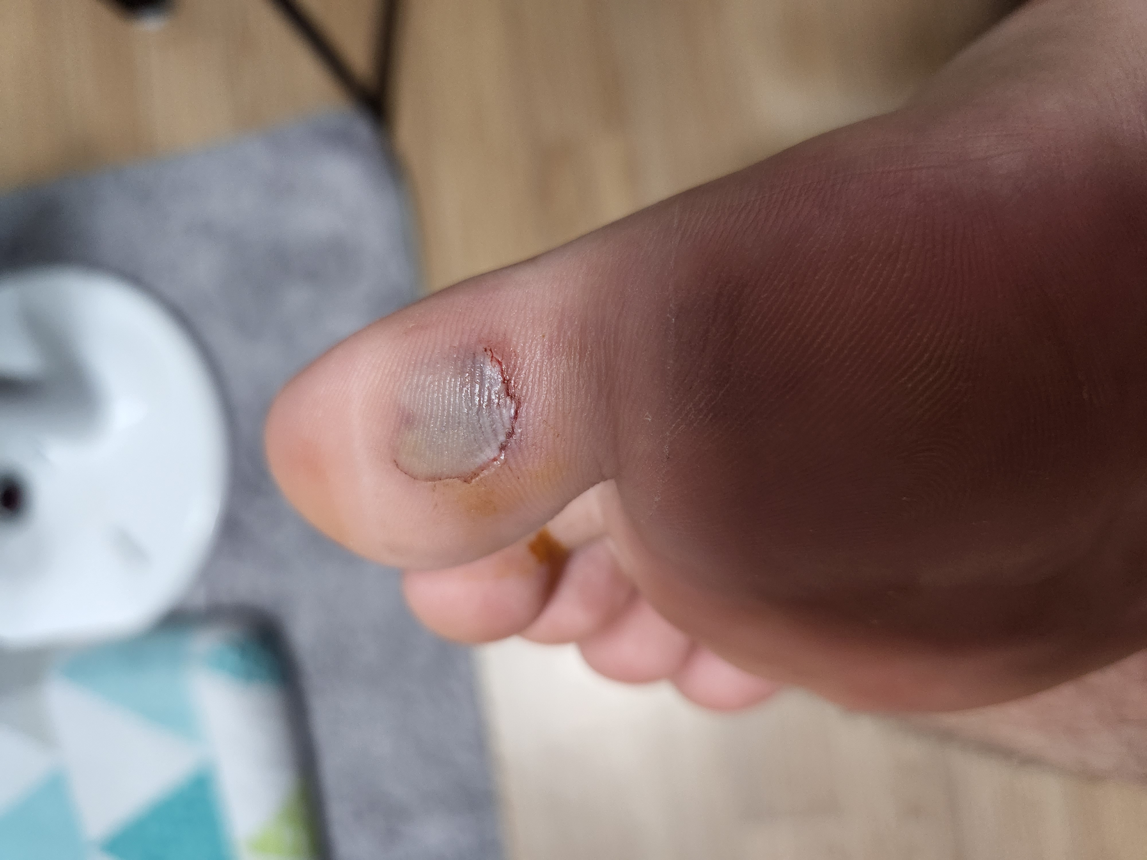 엄지발가락을 계단에 쓸렸습니다 ㅣ 궁금할 땐, 아하!