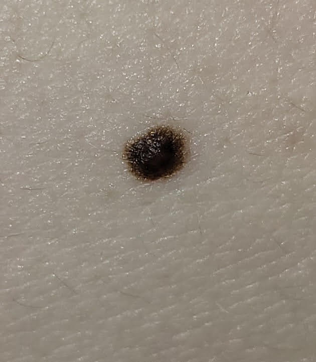 진한 까만점이 흑색종일 수 있을까요??? ㅣ 궁금할 땐, 아하!