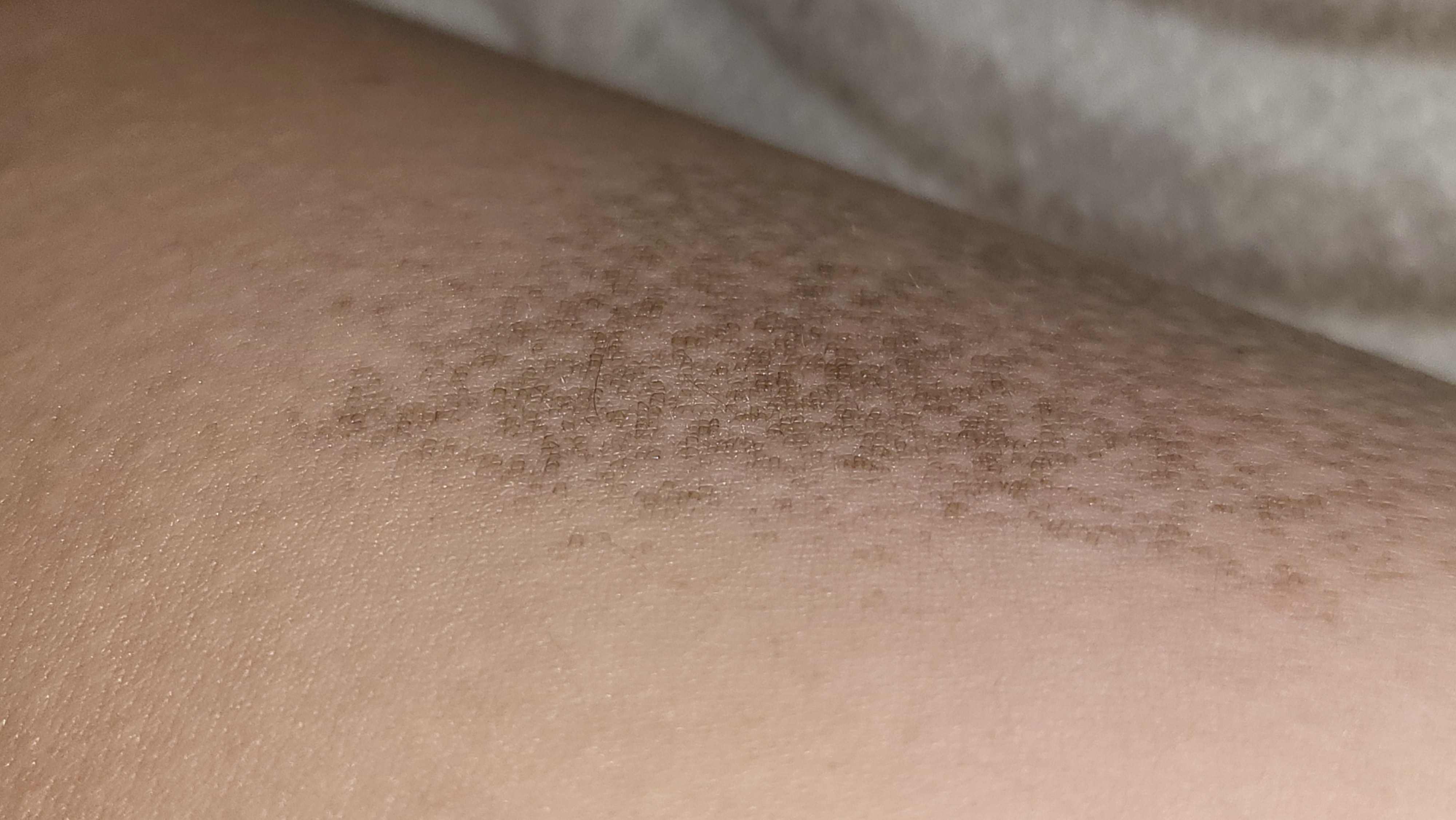 피부에 군집형으로 생긴 검은 모반에 대해 질문드립니다 ㅣ 궁금할 땐, 아하!