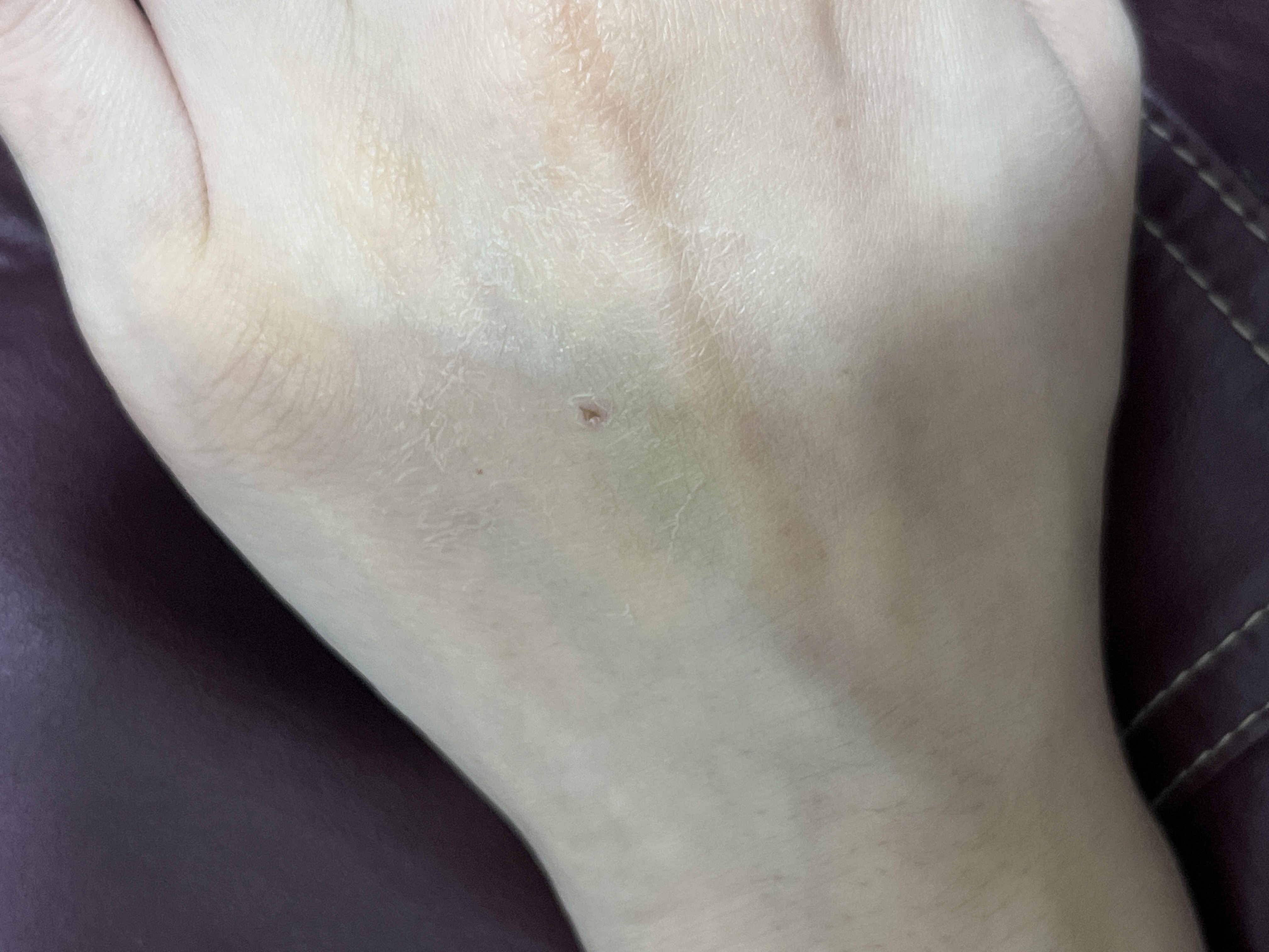 피 뽑고 나서 주사자리 근처에 피부가 뱀껍질처럼 되네요? ㅣ 궁금할 땐, 아하!